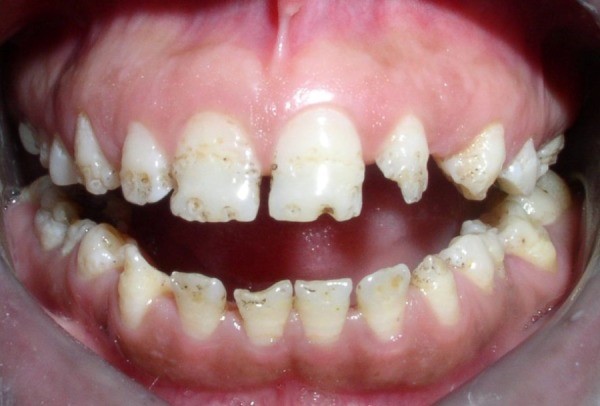 هیپوپلازی مینای دندان یا نقص مینای دندان