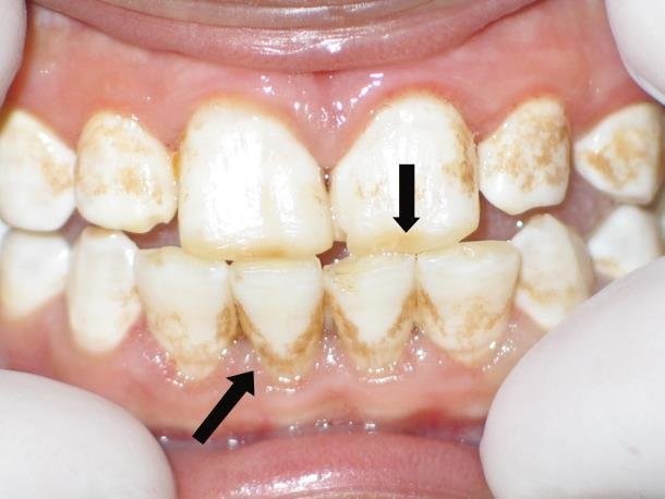 هیپوپلازی مینای دندان یا نقص مینای دندان