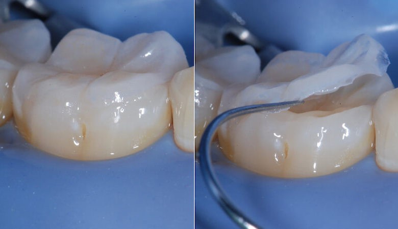 تفاوت پرکردن و ترمیم دندان