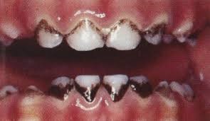 دندان های سیاه