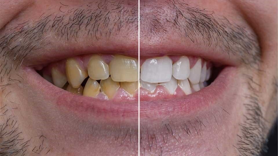سفید کردن دندان ها در خانه 