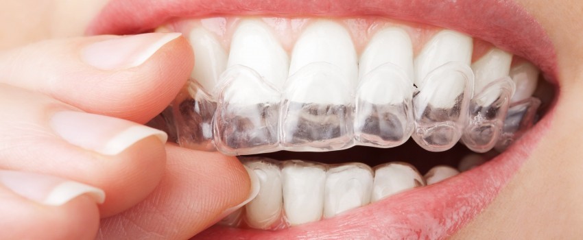 مراقبتهای بلیچینگ دندان