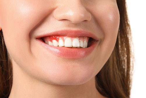 کامپوزیت دندان با بیماری لثه