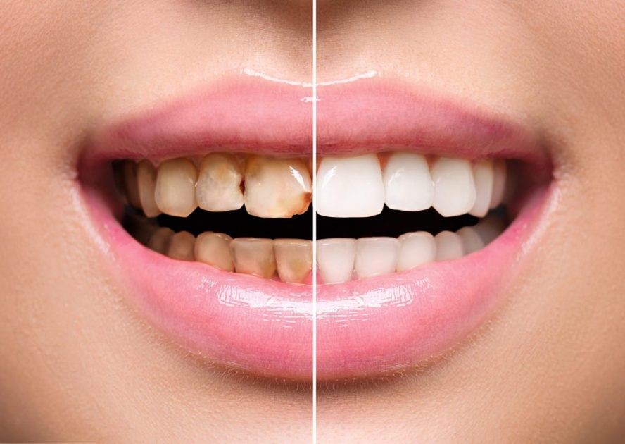 علل تغییر رنگ کامپوزیت دندان