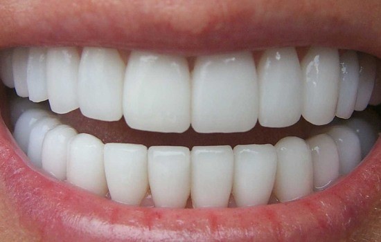 کامپوزیت دندان یا بلیچینگ