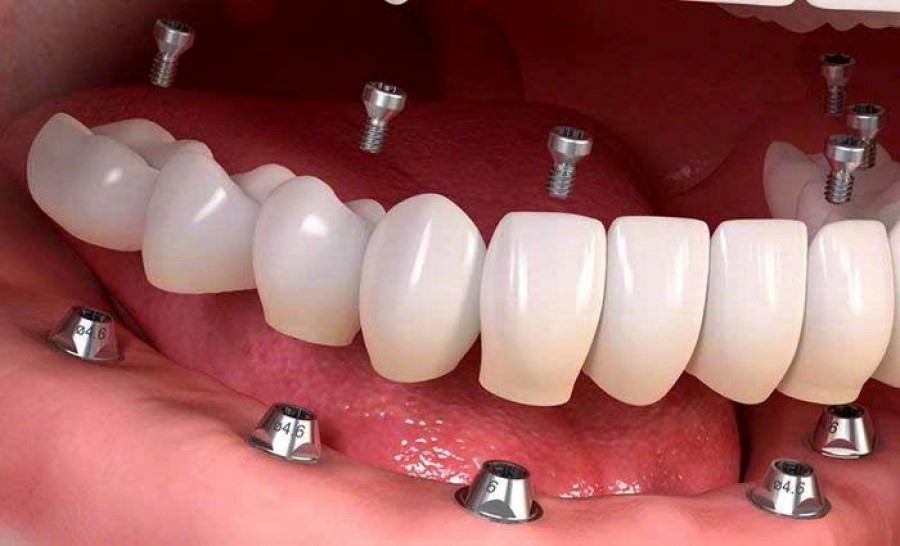 دندان مصنوعی فلیپر