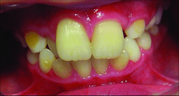 ماکرودنشیا یا درمان دندان های بزرگ