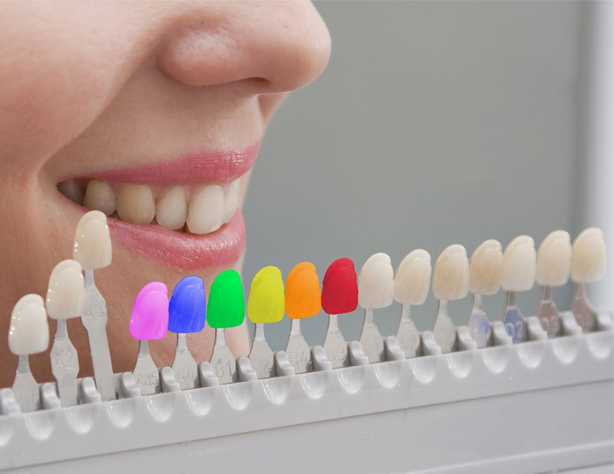 بهترین رنگ کامپوزیت دندان
