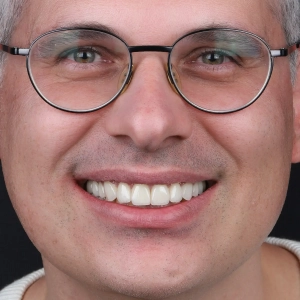 کامپوزیت بهتر است یا لمینت؟ تصمیمی که لبخند حرفهای شما را متحول میکند