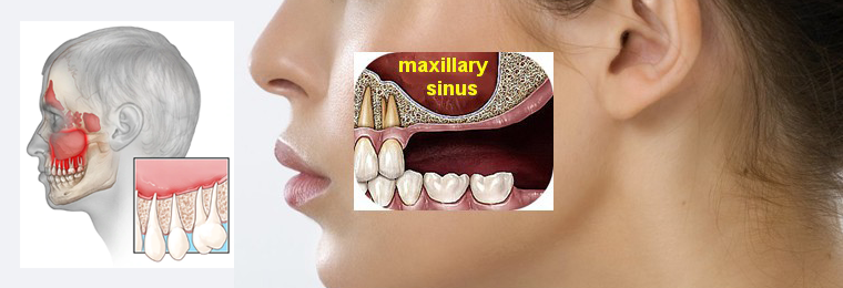 درمان درد دندان سینوسی 