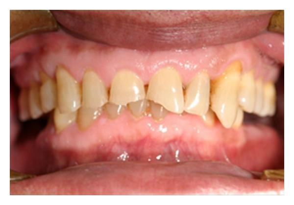 مشکلات گوارشی و تخریب دندان