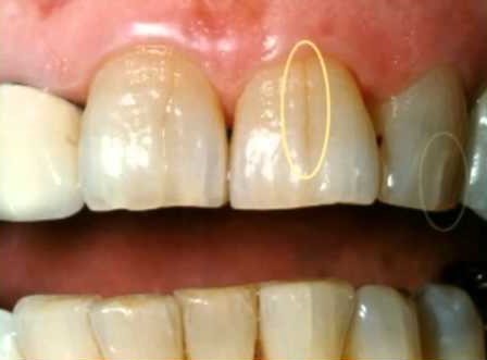علت ترک دندان