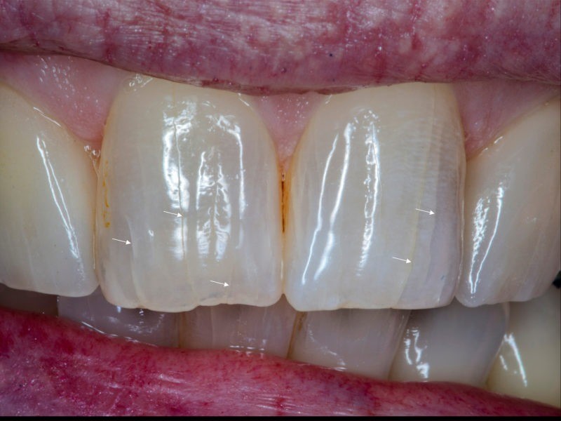علت ترک دندان