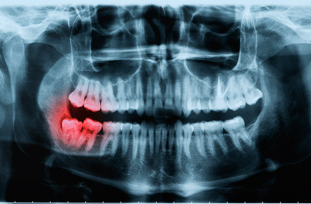 بی حسی زبان بعد از جراحی دندان عقل