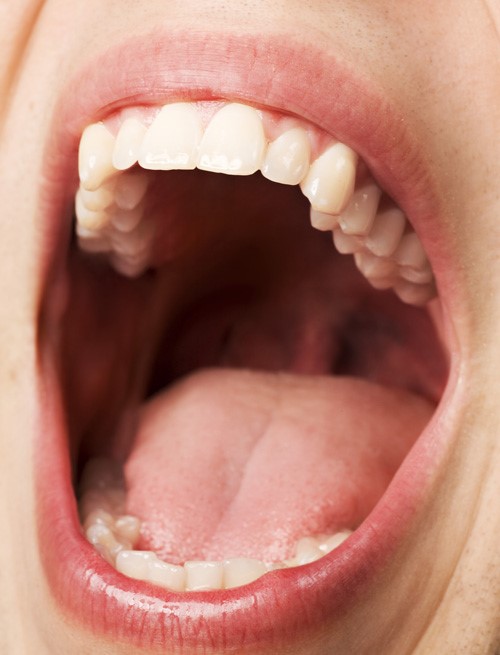بی حسی زبان بعد از جراحی دندان عقل