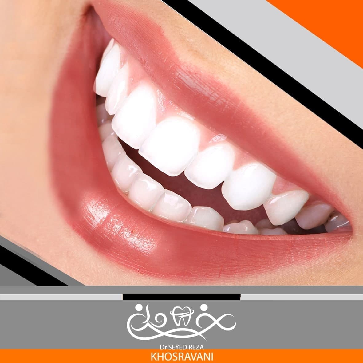 مزایای کامپوزیت دندان ( کامپوزیت ونیر )