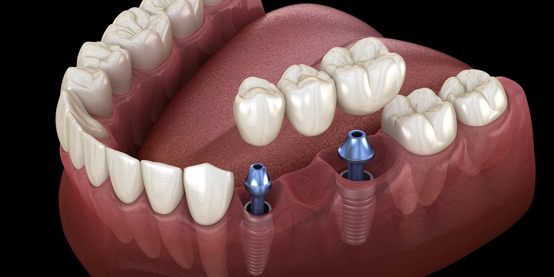 طول عمر یا دوام ایمپلنت دندان