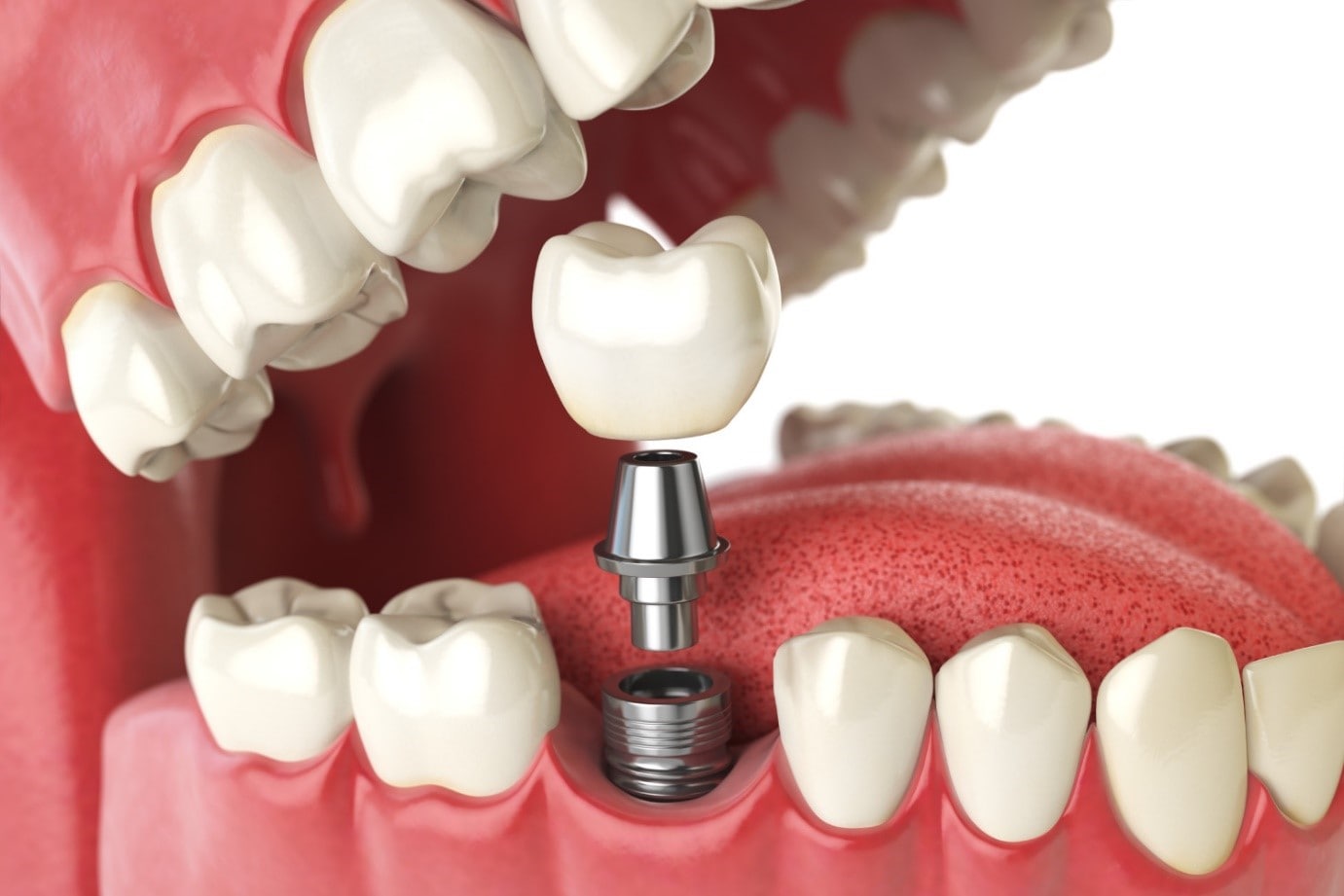 راهکارهایی برای افزایش دوام و طول عمر ایمپلنت دندان