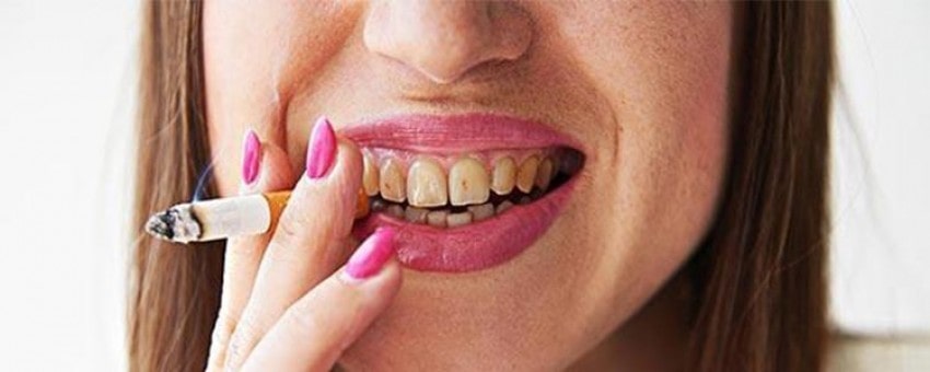 چگونگی برطرف کردن آثار سیگار از روی دندان ها
