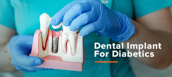 تاثیر دیابت بر انتخاب ایمپلنت دندان به عنوان درمان