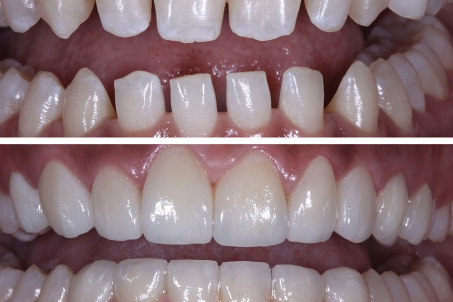 مقایسه بین لمینت با ایمپلنت دندان