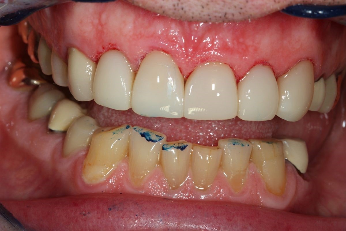 تاثیرات کلی قلیان کشیدن بر سلامت دهان و دندان