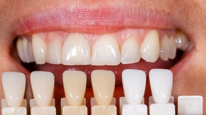 آیا قلیان کشیدن می‌ تواند بر دندان های کامپوزیت شده تاثیر گذارد؟