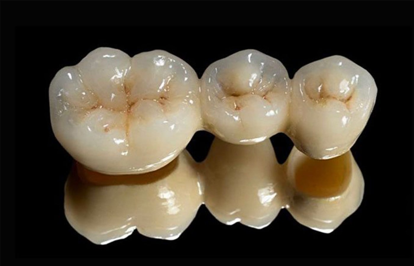 معرفی انواع روکش های دندانی