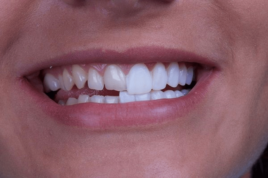 چه مشکلاتی با کامپوزیت دندان قابل برطرف کردن است؟