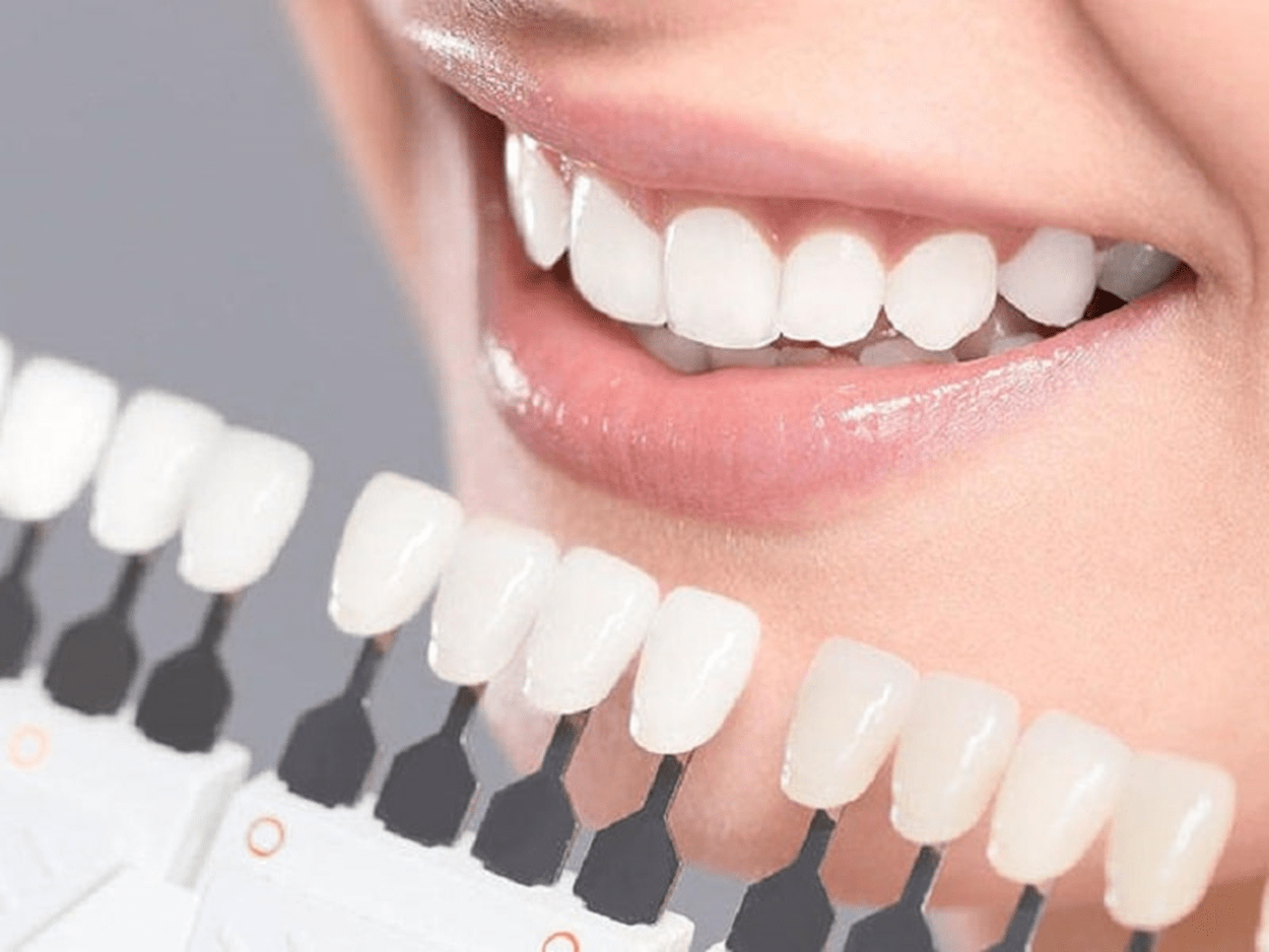 مزایای کامپوزیت دندان چیست؟