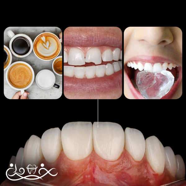 ✅ عوارض لمینت دندان و نحوه پیشگیری 🔬