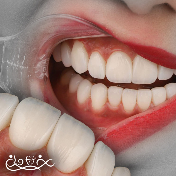 لمینت دندان چیست؟ راهنمای جامع از نگاه یک متخصص زیبایی دندان در ولنجک 🦷