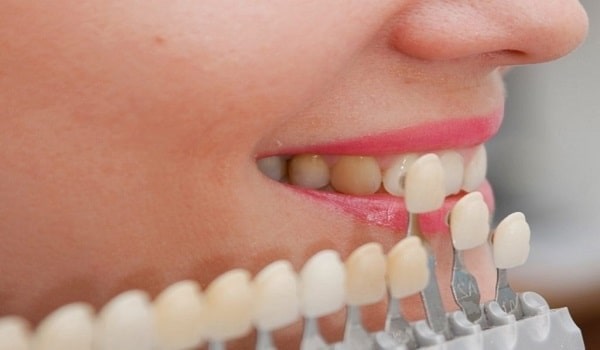 رنگ بندی لمینت دندان بر چه اساس است؟