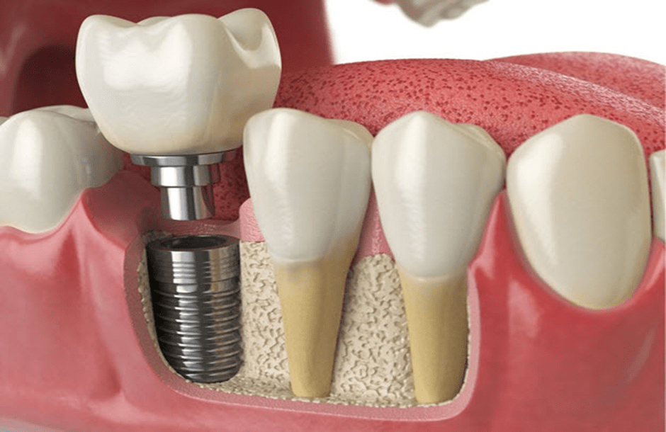 با ایمپلنت دیجیتالی، تعداد دفعات مراجعه به دندانپزشک را به حداقل برسانید. 
