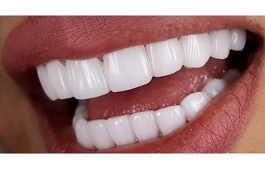 فاکتورهای اساسی بر هزینه نهایی کامپوزیت دندان