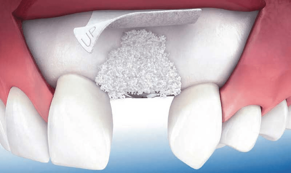 بهترین نوع پیوند استخوان برای کاشت ایمپلنت دندان
