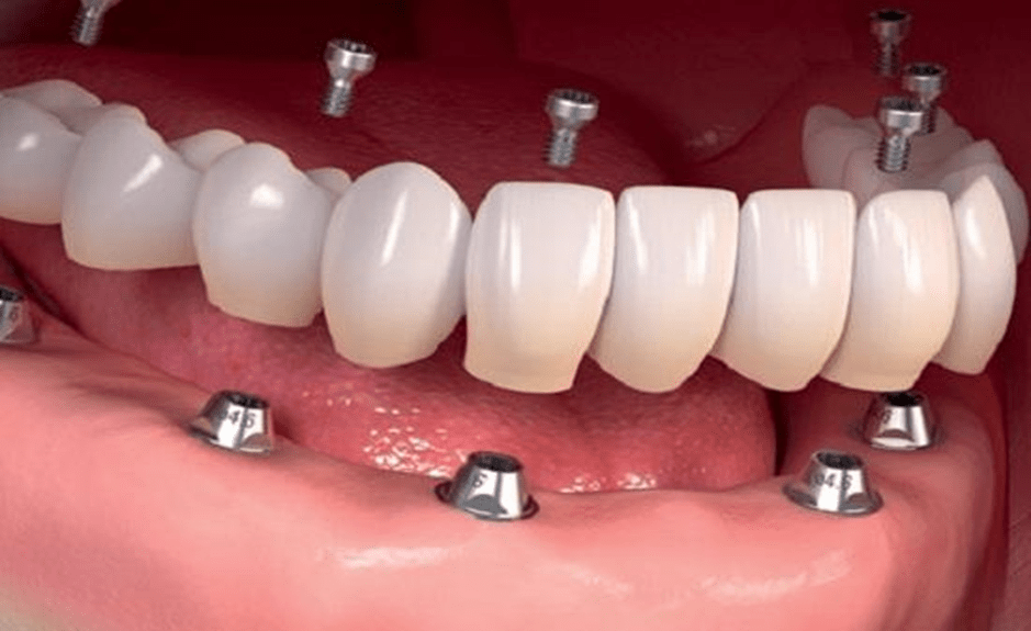 ایمپلنت فول موس چه تفاوتی با دندان مصنوعی دارد؟ 