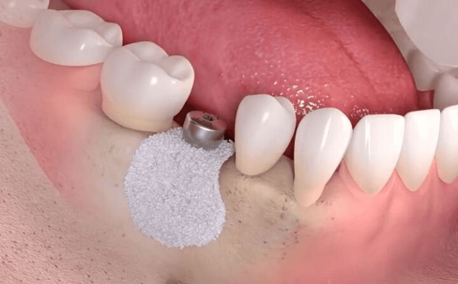 پیوند استخوان فک برای کاشت ایمپلنت دندان