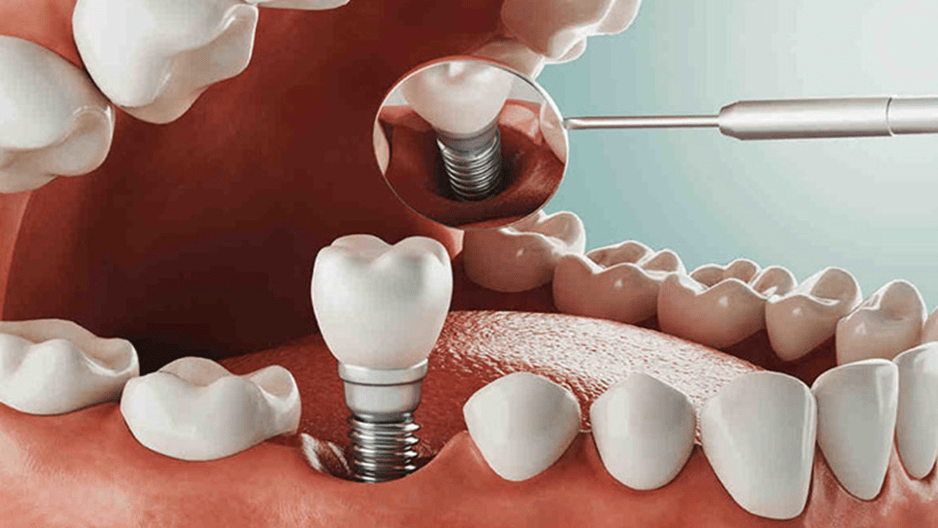 ایمپلنت پانچ یا بدون درد روشی کارآمد و ایمن برای کاشت دندان