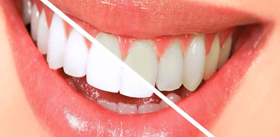 معایب بلیچینگ دندان با لیزر