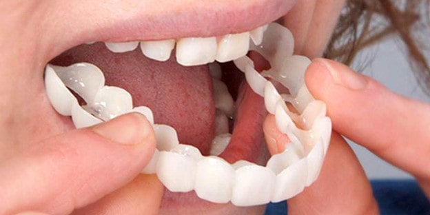 لمینت متحرک دندان یا اسنپ آن اسمایل چیست؟
