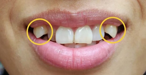 لمینت دندان نیش بیرون زده چگونه انجام می شود؟