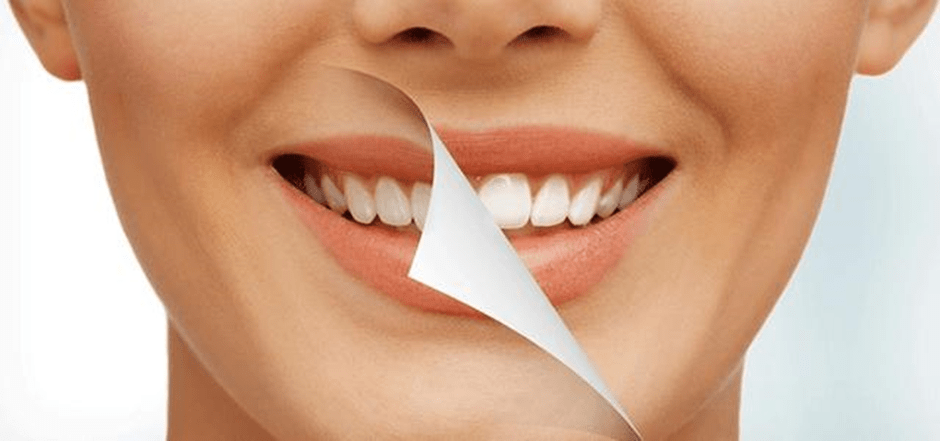 آیا انجام بلیچینگ دندان با بیمه امکان پذیر است؟
