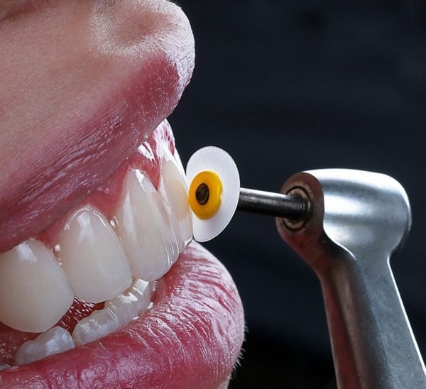 علت تراشیدن دندان برای لمینت چیست؟