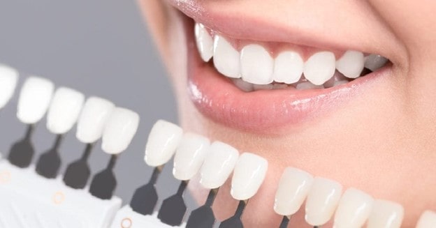 عوامل موثر بر میزان تراش مینای دندان قبل لمینت