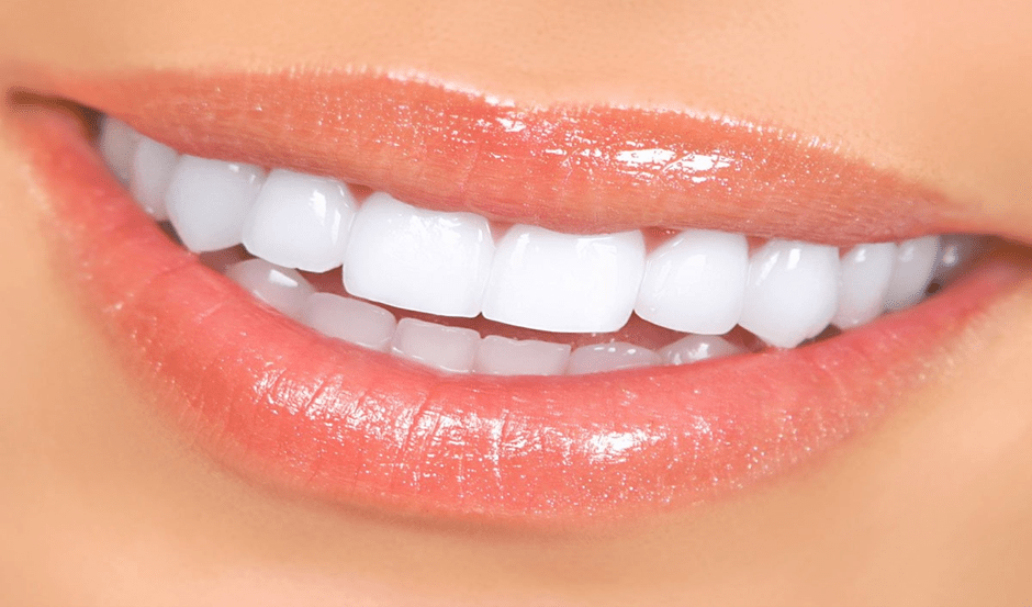 هزینه و شرایط کامپوزیت اقساطی دندان به چه صورت است؟
