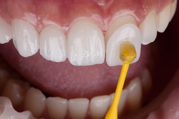 آیا نصب لمینت دندان بدون تراشیدن امکان پذیر است؟