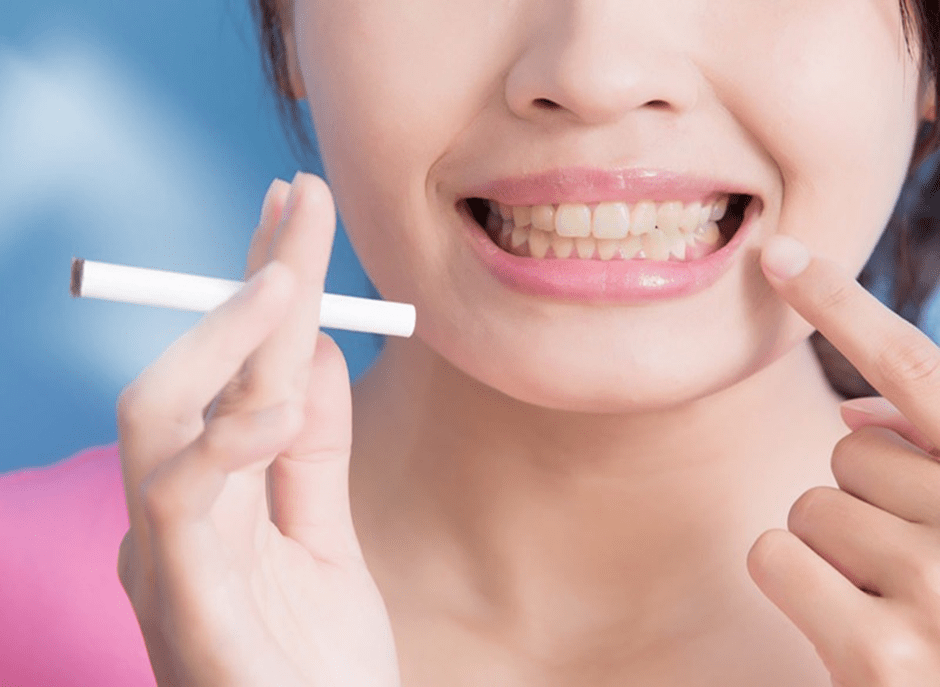 چگونگی تاثیر سیگار بر لمینت دندان