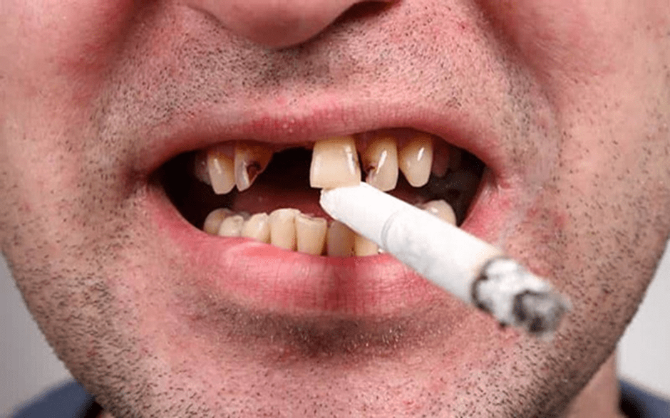 روش های پیشگیری از تاثیر سیگار بر لمینت دندان