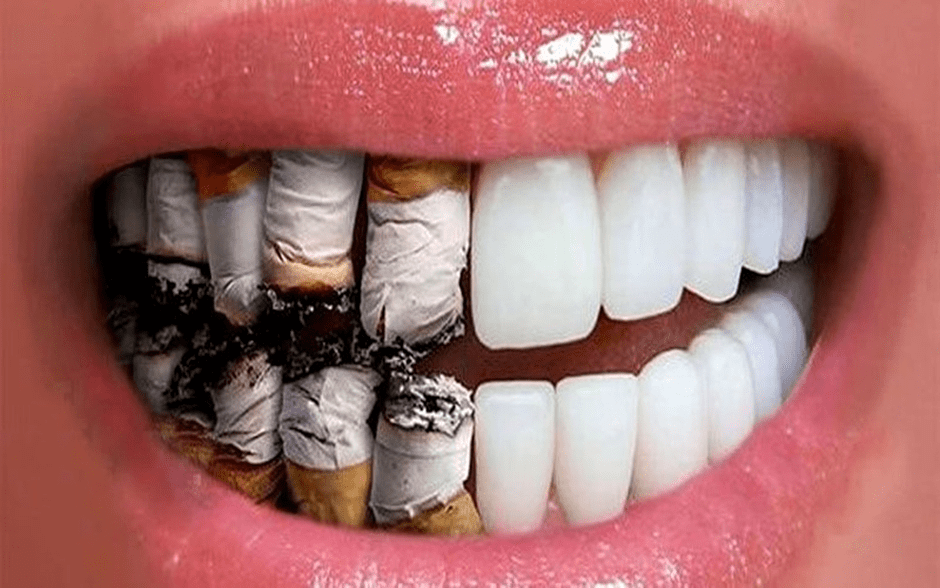 پیامدهای بلند مدت تاثیر سیگار بر لمینت دندان